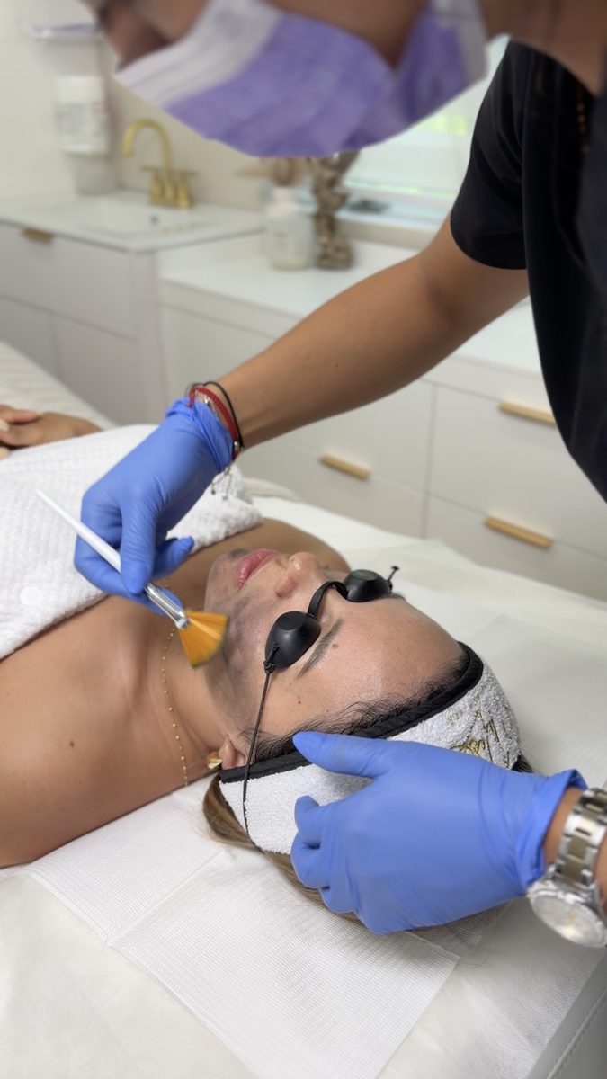 Carbon peel láser facial Hollywood en Milu Beauty Spa, Hampton Bays
