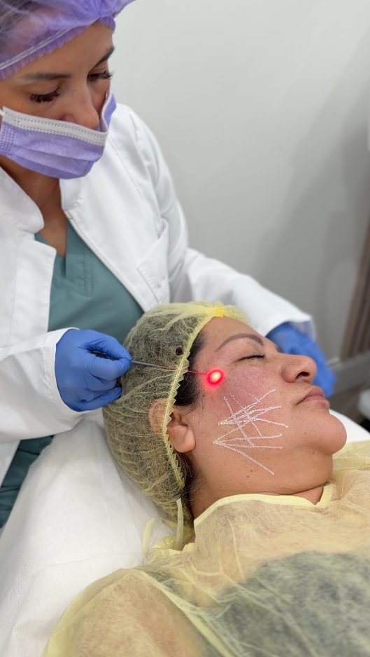 Lifting facial sin cirugía y tensado de piel en Milu Beauty Spa, Hampton Bays