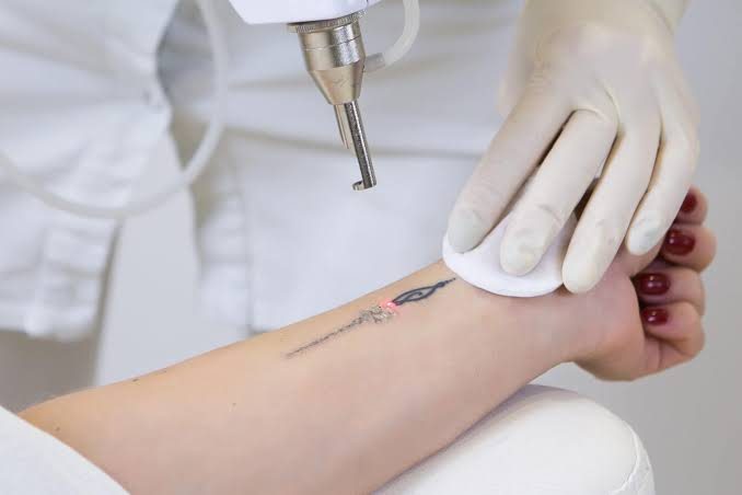 Eliminación de tatuajes con láser en Milu Beauty Spa, Hampton Bays